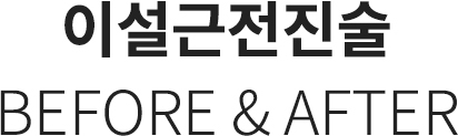 이설근전진술을 비포애프터
